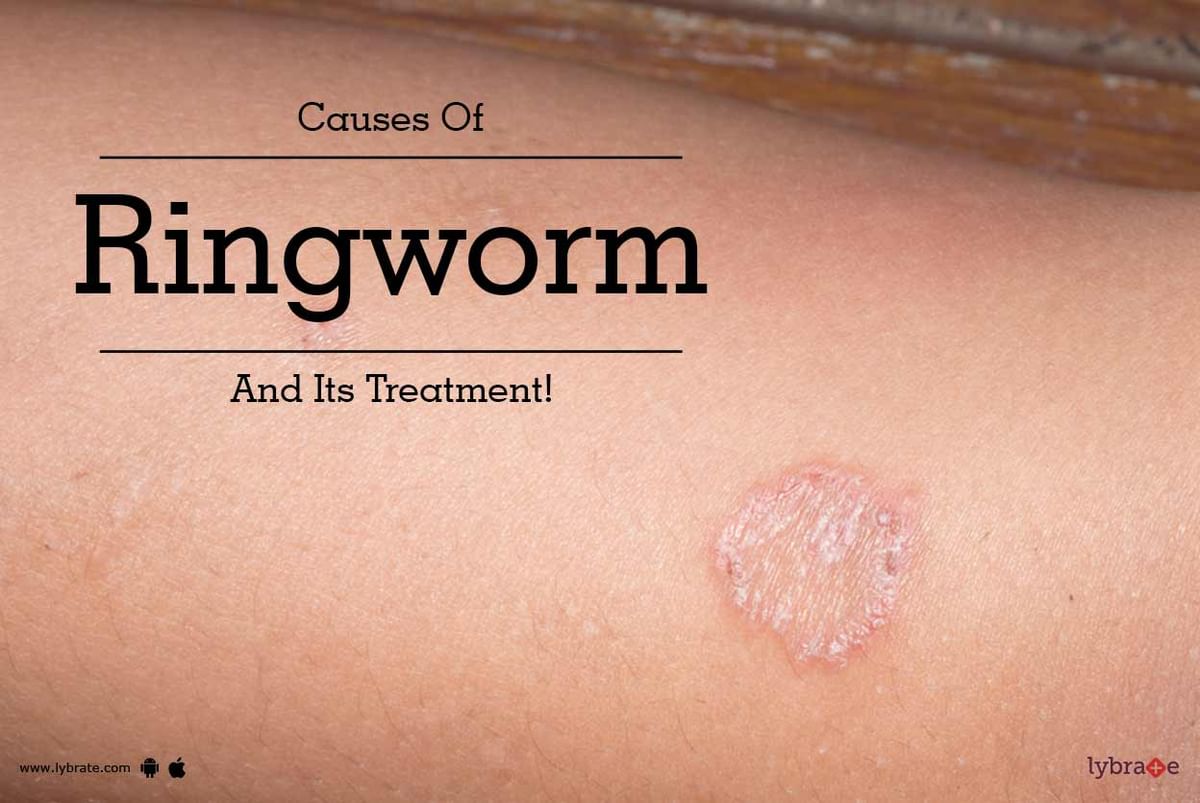 causes-of-ringworm-and-its-treatment-by-dr-shivashankar-b