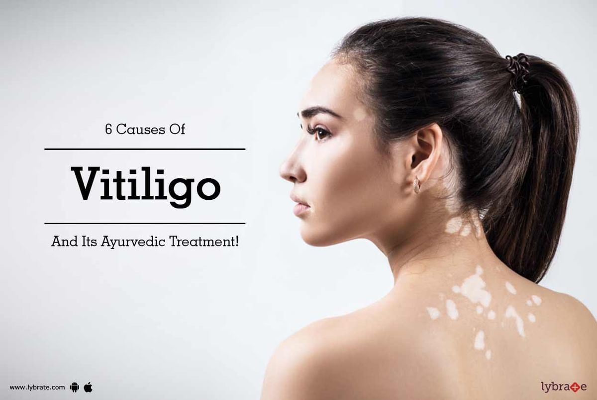 6 Causes Of Vitiligo And Its Ayurvedic Treatment! - By Dr. Bhujbale's ...