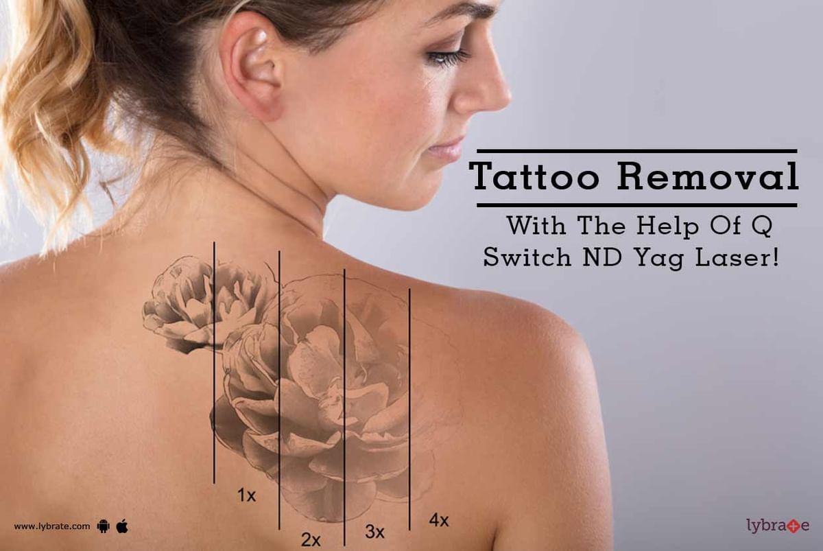Everything You Should Know About Tattoo Removal