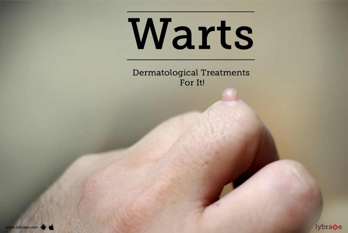 Warts Dermatological Treatments For It By Dr Deepti Dhillon Lybrate