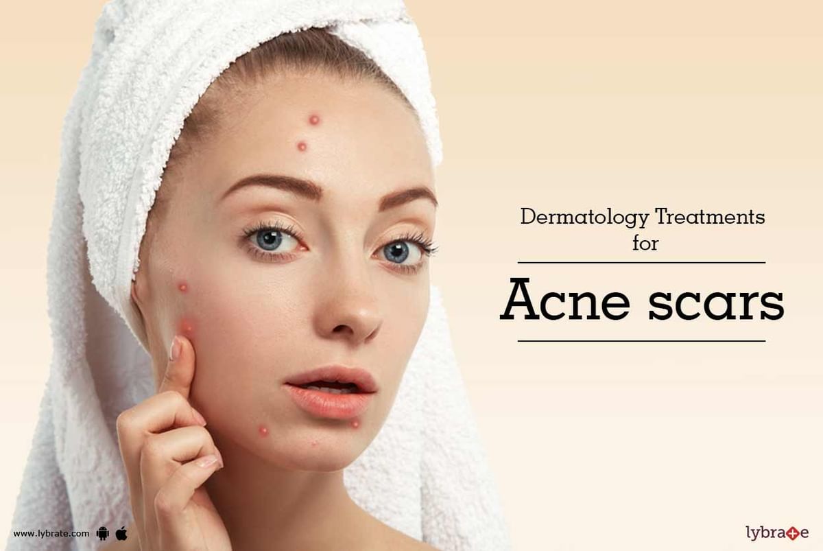 Dermatology Treatments for Acne scars - By Dr. Sridhar Gogineni | Lybrate
