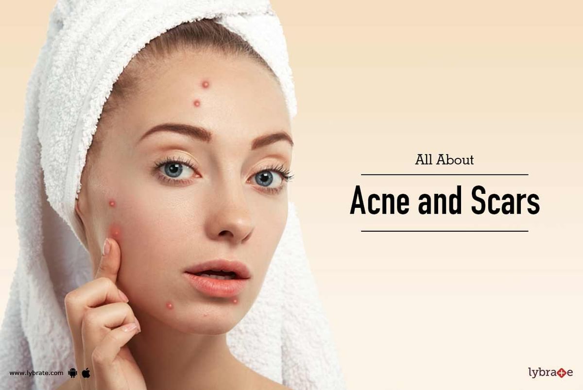 All About Acne and Scars - By Dr. Rittika Walia | Lybrate