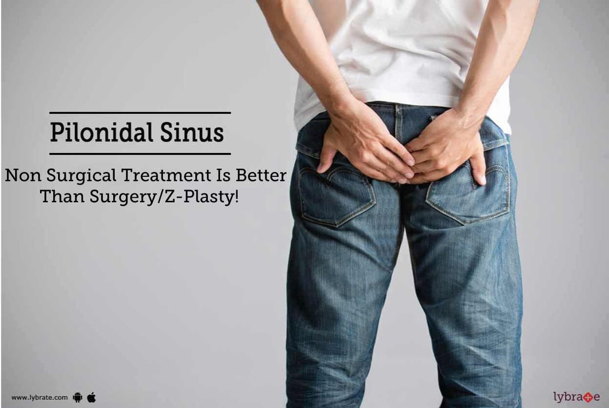 pilonidal-sinus-non-surgical-treatment-is-better-than-surgery-z