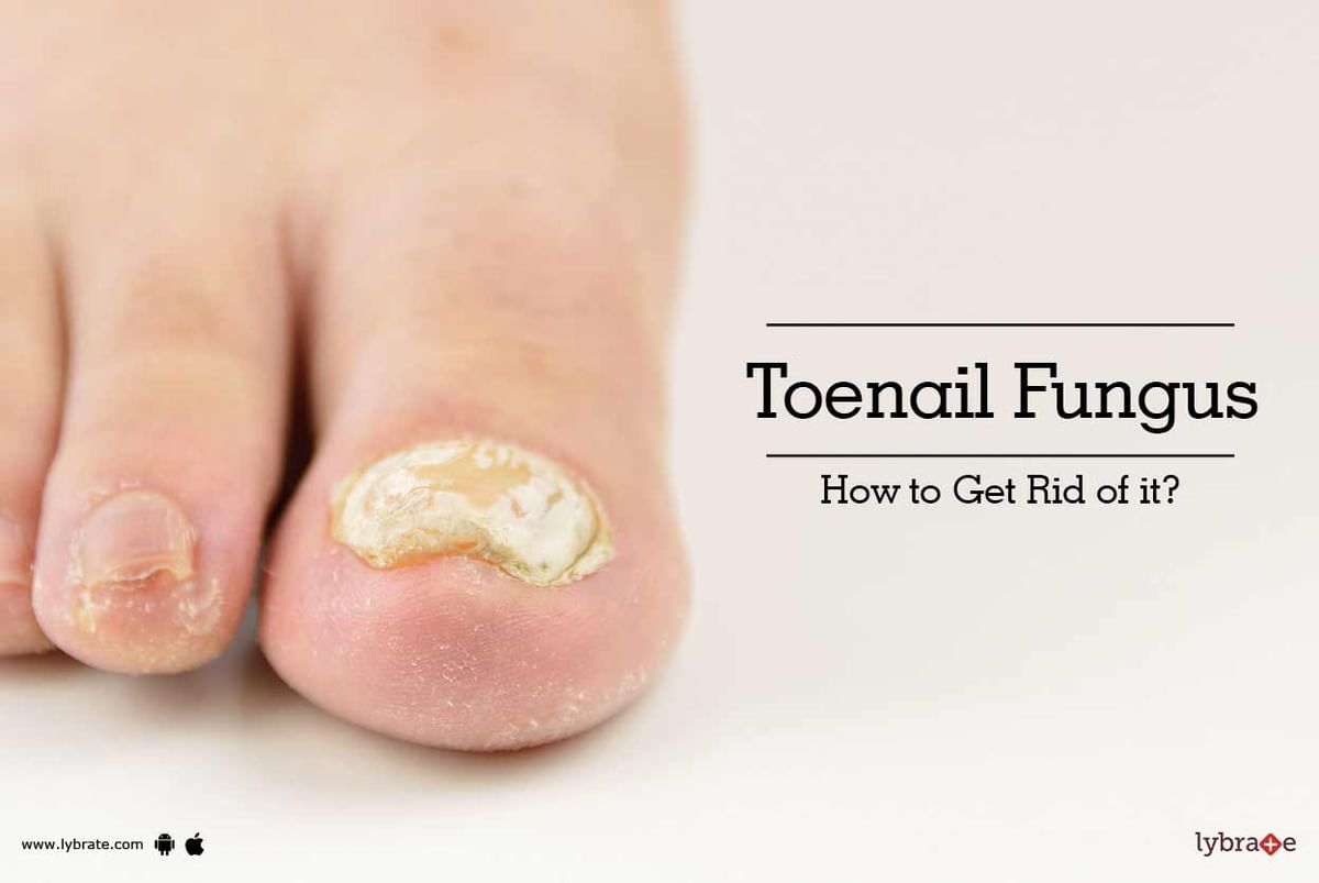 Toenail Fungus - How to Get Rid of it? - By Dr. Rashmi Sharma | Lybrate