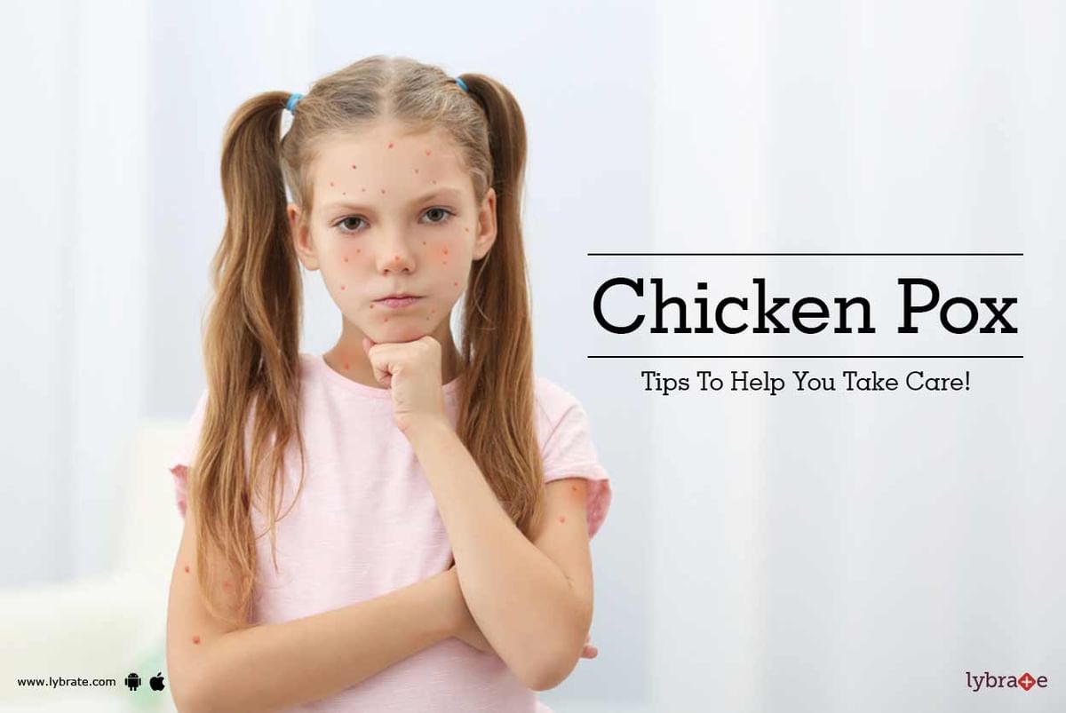 chicken-pox-tips-to-help-you-take-care-by-dr-nash-kamdin-lybrate