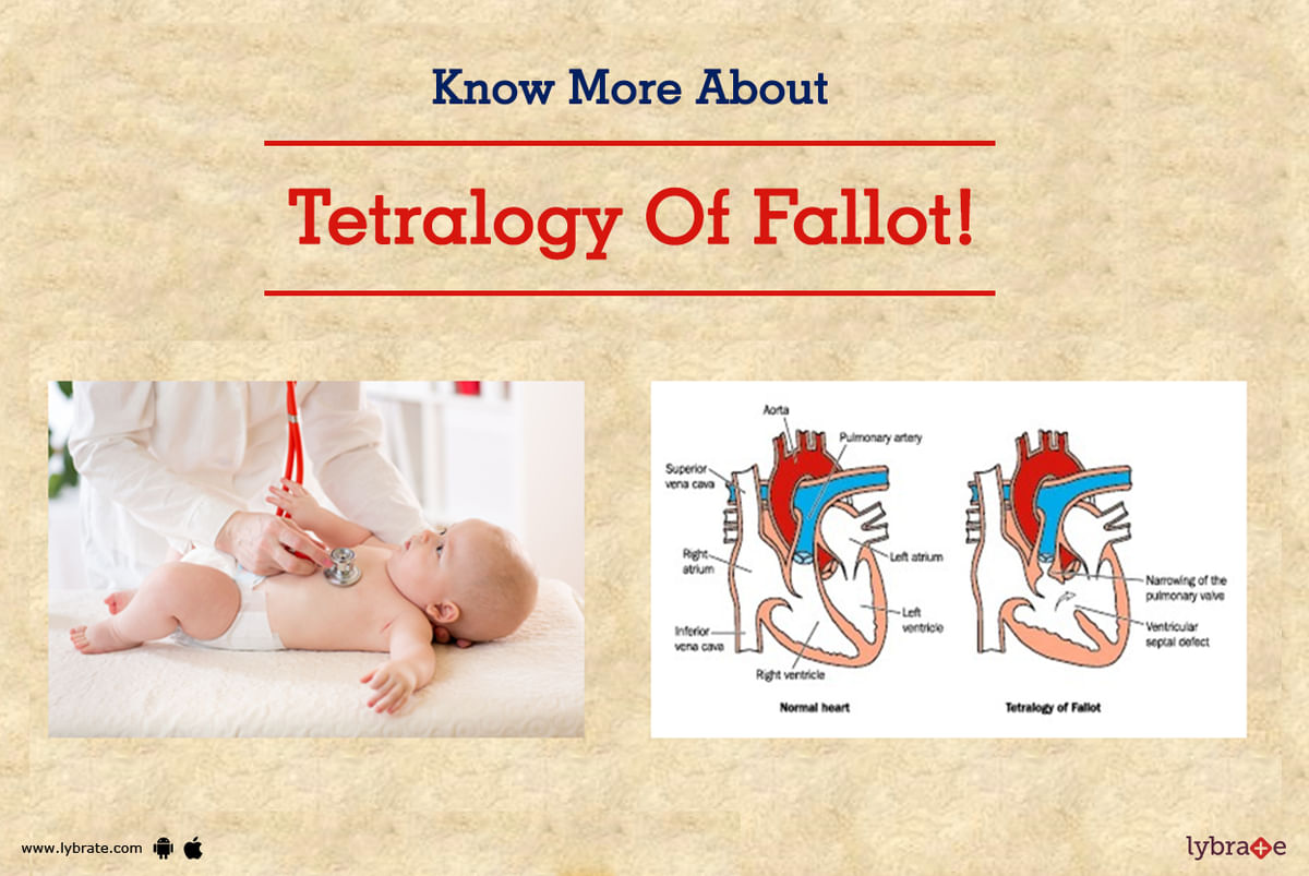 Know More About Tetralogy Of Fallot! - By Dr. Gaurav Agrawal (Pediatric ...