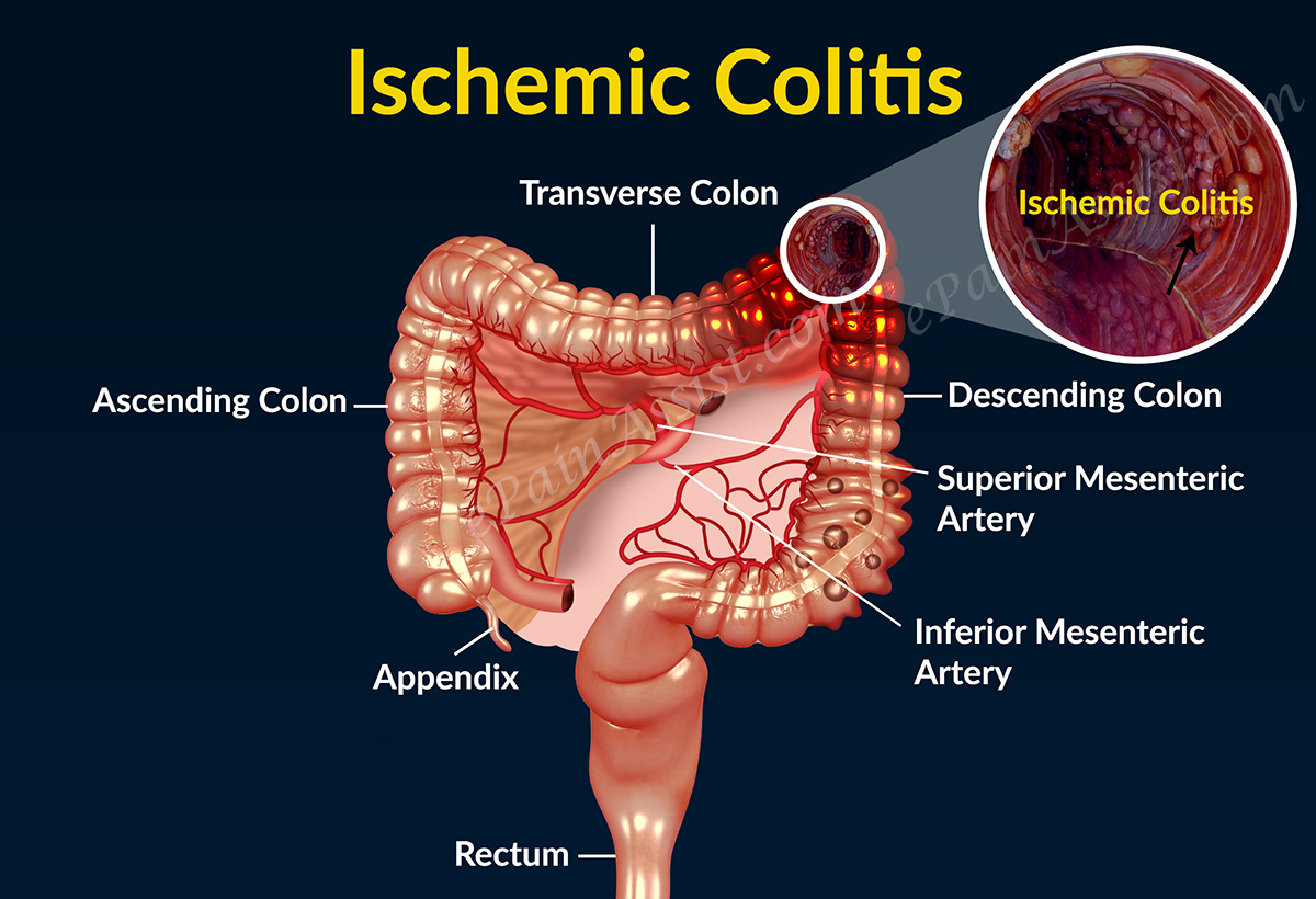 Ischemic Colitis In Depth Of It! By Dr. Radhika Amulraj Lybrate