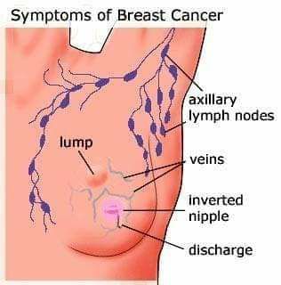 Is a lump in your breast always cancer? 4 signs of breast cancer