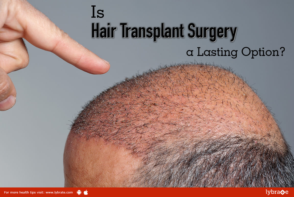 Is Hair Transplant Surgery a Lasting Option? - By Dr. Sandesh Gupta |  Lybrate