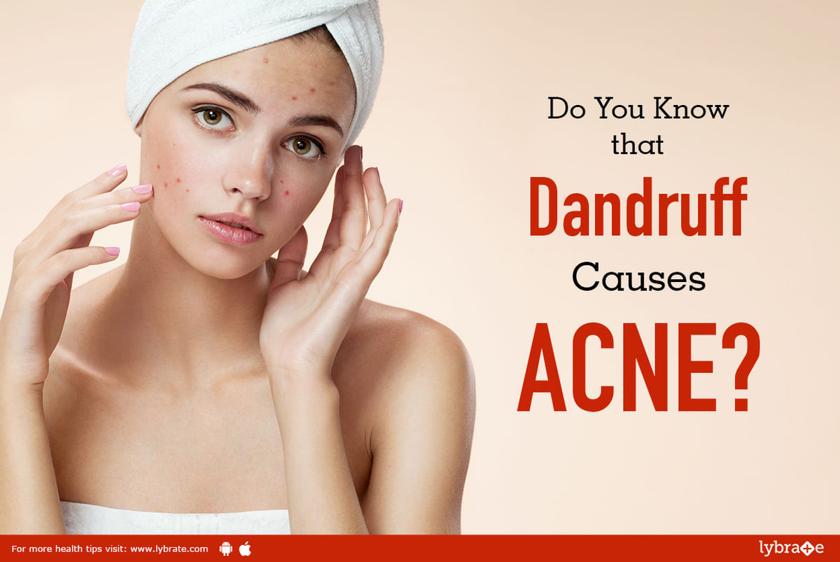 Do You Know that Dandruff Causes ACNE? - By Dr. Rajeshwari K A Bhat |  Lybrate