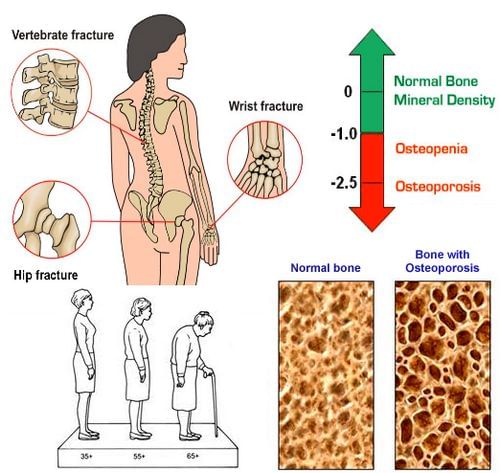 Osteoporosis And Exercises By Dr Vipsa Gupta Lybrate