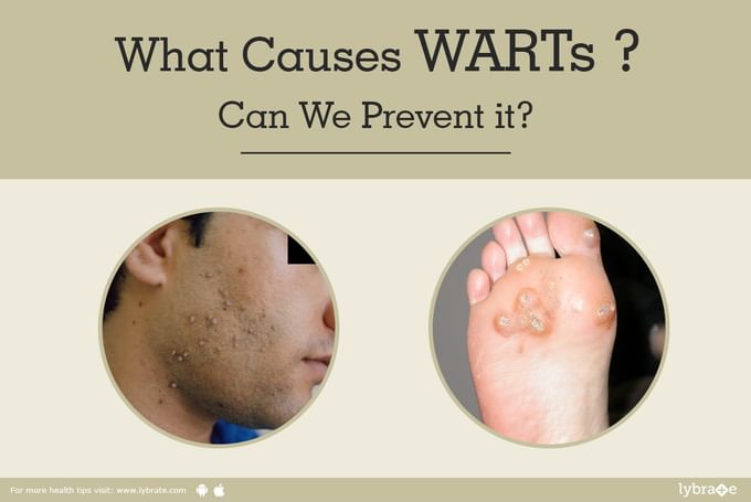 what-causes-warts-can-we-prevent-it-by-dr-akhilendra-singh-lybrate