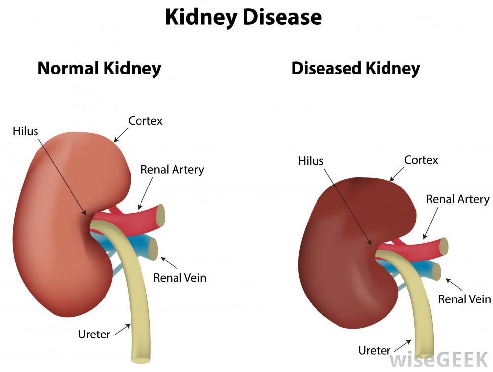 Abnormal Kidney Function Know More About It! By Dr. Radhika Amulraj Lybrate