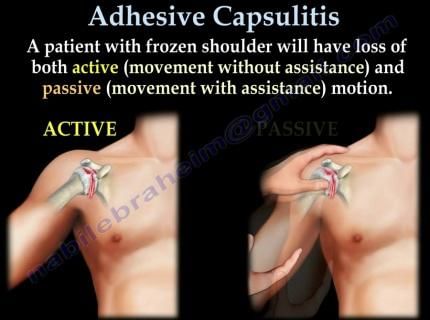 Adhesive Capsulitis An Overview By Dr Radhika Amulraj Lybrate 3635