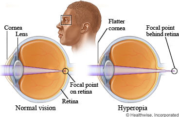 Зрение плюс 5. Зрение при близорукости. Близорукость хрусталик. Миопия глаза что это такое. Миопия хрусталик.