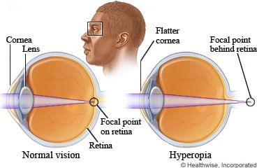 6-different-options-to-treat-farsightedness-hyperopia-eye-problem