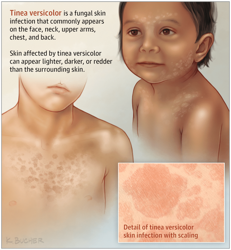 Tinea Versicolor - Know More About It! - By Dr. Radhika Amulraj