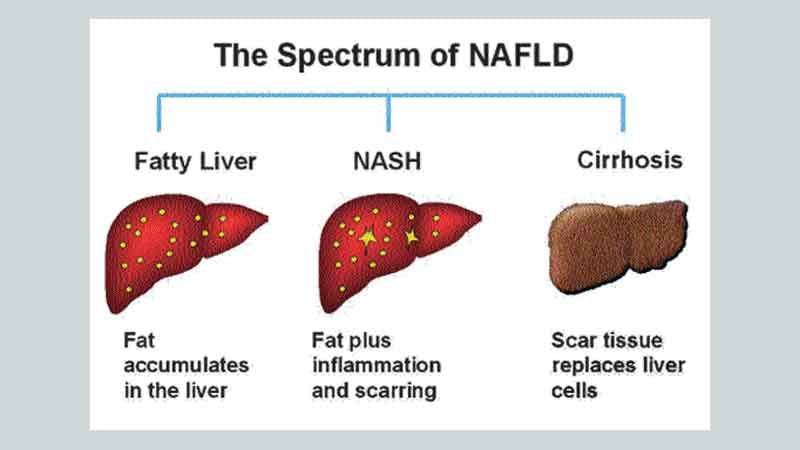 Fatty Liver Causes Symptoms Treatment And Prevention By Dr Radhika Amulraj Lybrate 3636