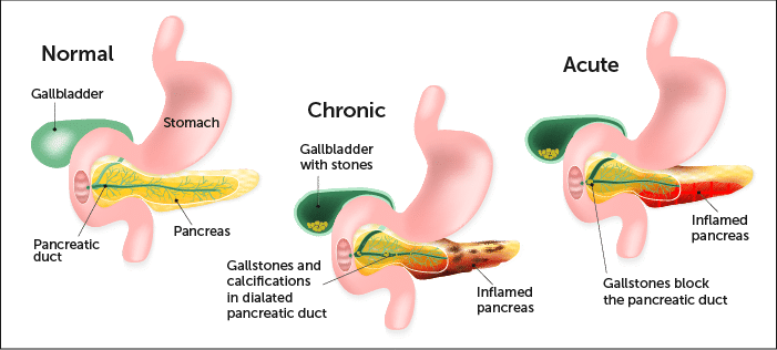 Pancreatitis Know More Of It By Dr Radhika Amulraj Lybrate