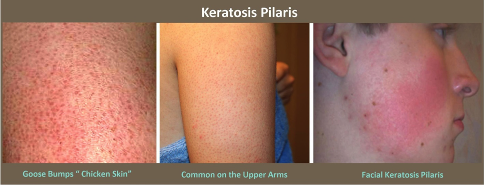 ghk cu keratosis pilaris Keratosis Pilaris - Know More About It! - By Dr. Radhika Amulraj
