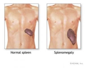 Enlarged Spleen Symptoms Causes Diagnosis Treatment By Dr