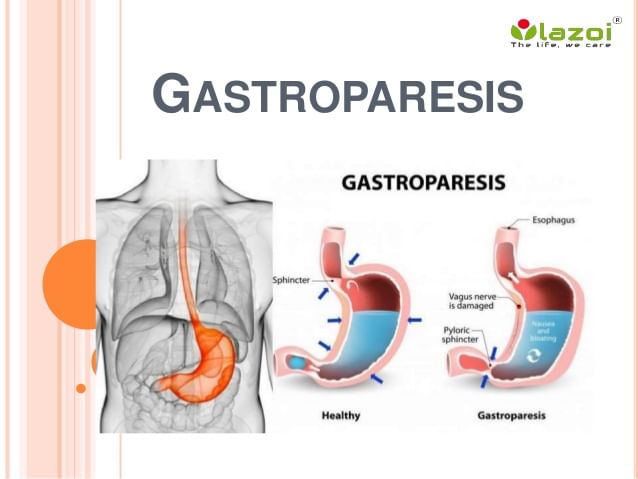 Best Treatment for Gastroparesis - 7 Different Ways - By Dr. Radhika A (Md) | Lybrate
