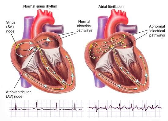 All About Abnormal Heart Rhythms By Dr Radhika Amulraj Lybrate 4964