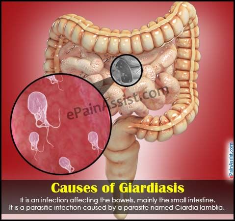 Treatment Of Giardia Infection By Dr Radhika Amulraj Lybrate 0765