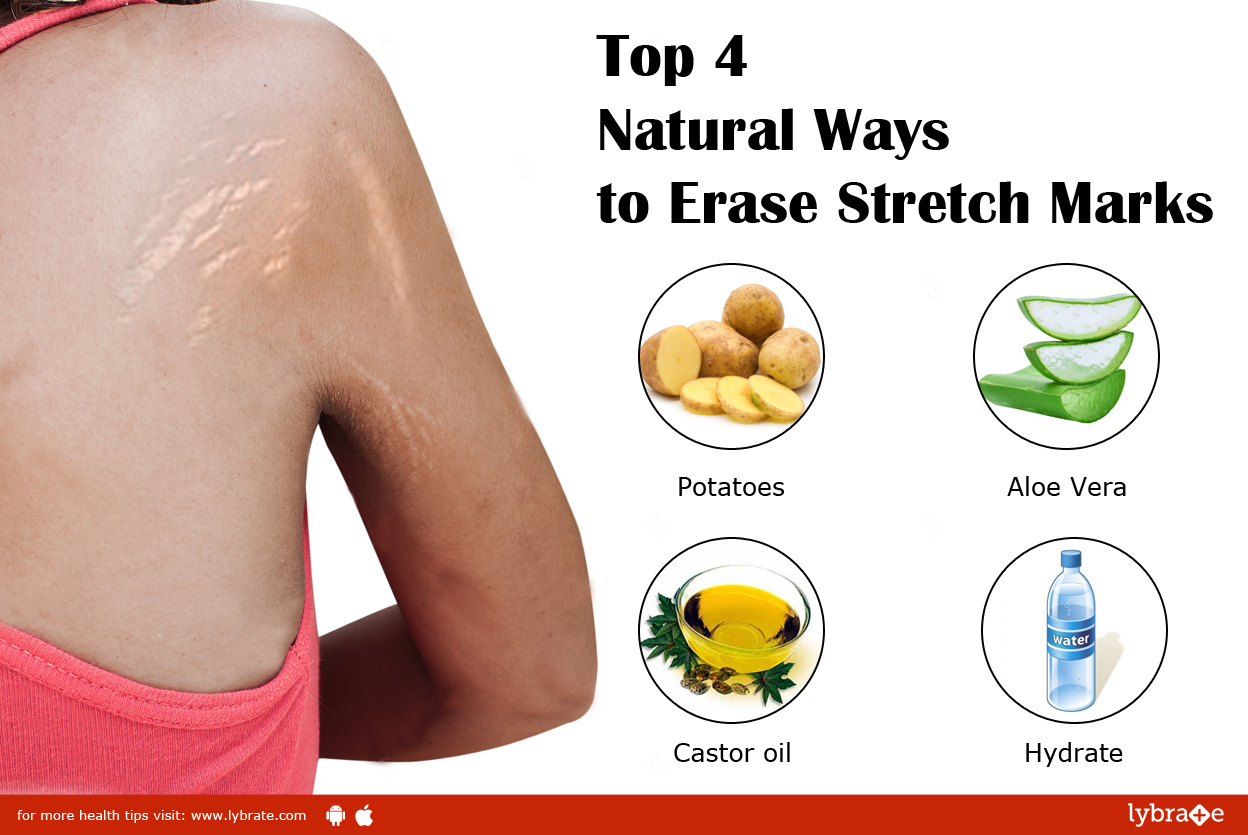 Graphic: Top 4 Natural Ways to Erase Stretch Marks including castor oil, aloe vera, potatoes, hydrate