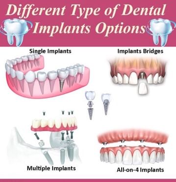 Types Of Dental Implants! - By Dr. Puneet Kansal | Lybrate