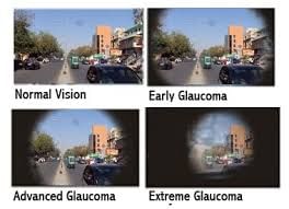 Glaucoma - A Silent Killer Of Eye Sight! - By Dr. Mukesh Paryani | Lybrate