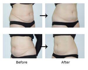 Belly injection of injection lipolysis, body shaping treatment