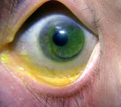 EXTENDED WEAR OXYGEN PERMEABLE CONTACT LENSES By Dr. Prof M R Jain