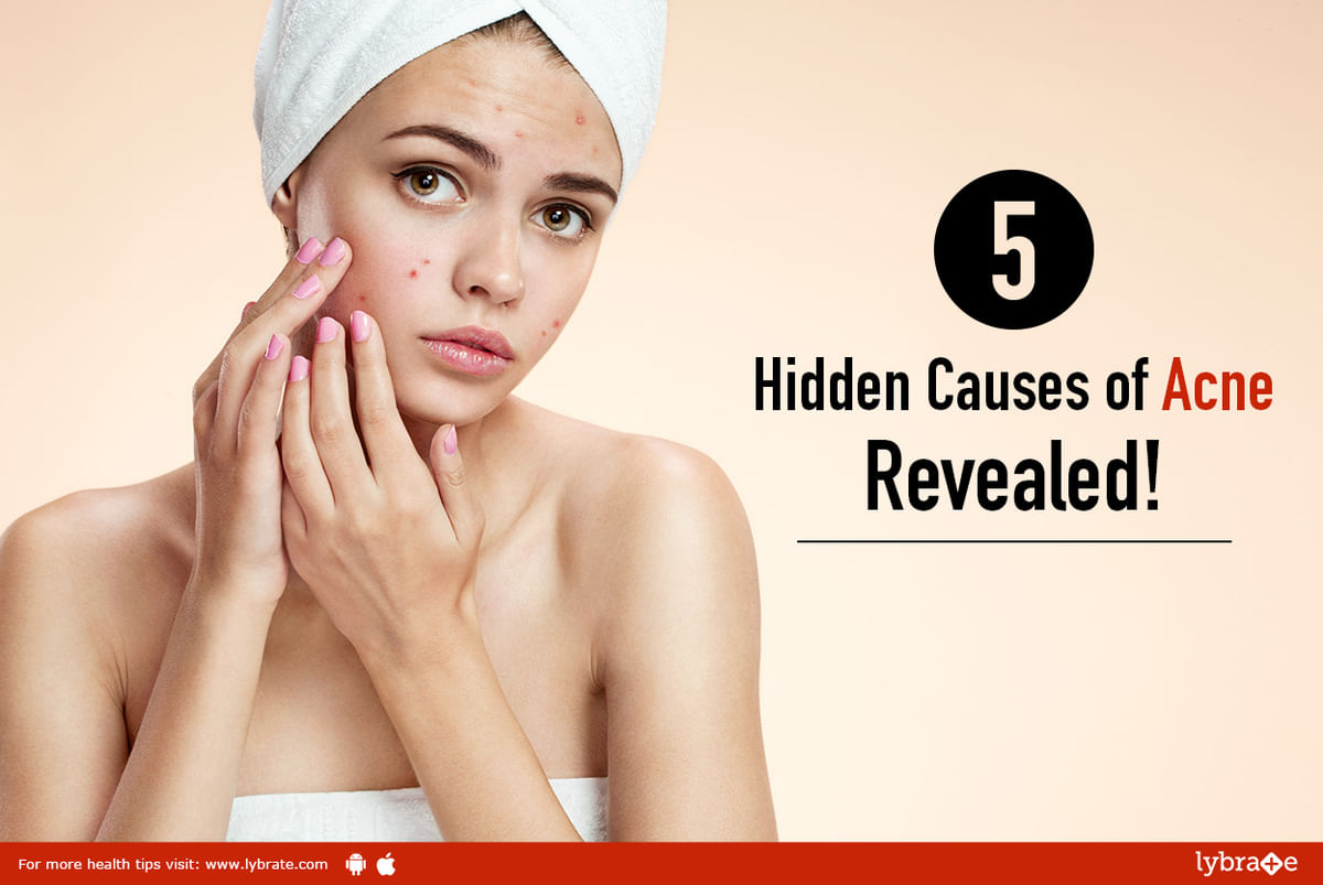 5 Hidden Causes of Acne, Revealed! - By Dr. Swapnil Sanghavi | Lybrate