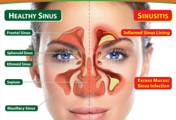 Top 5 SinusRelief Home Remedies By Dr. Anurag Srivastava Lybrate