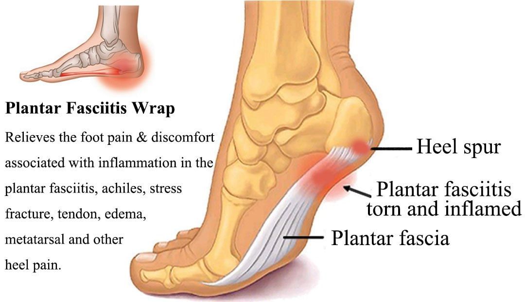 Bruised Heel - Symptoms, Causes, Treatment & Taping