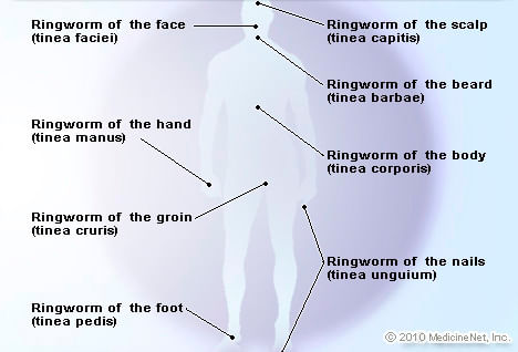 Tinea (Ringworm) - Causes, Symptoms & Prevention - By Dr. Maruboina ...