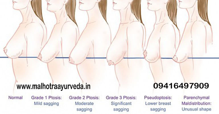 How To Prevent Sagging of Breasts? - By Dr. Malhotra Ayurveda