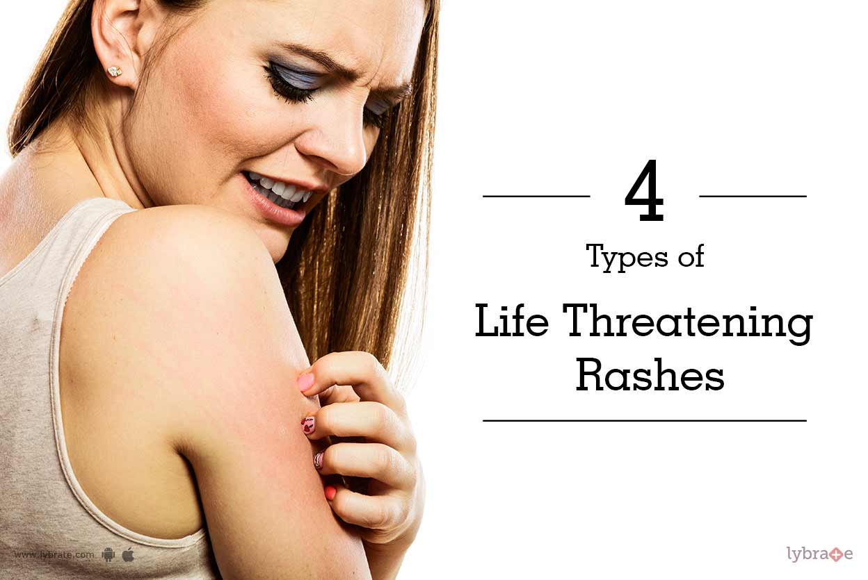 4 Types of Life-Threatening Rashes - By Dr. Nivedita Dadu | Lybrate