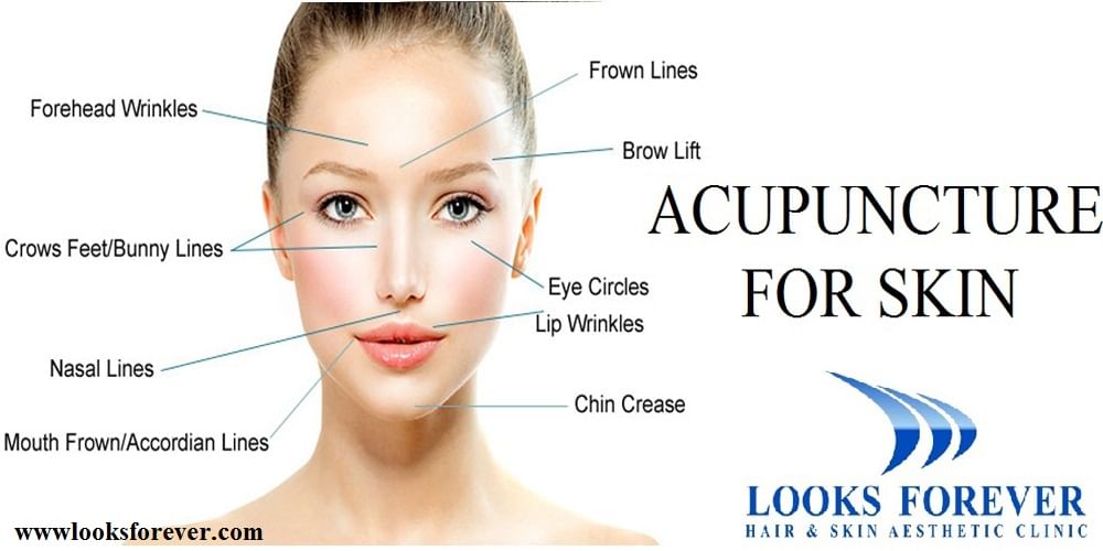 How Acupuncture can Treat Skin? - By Looks Forever Hair And Skin ...