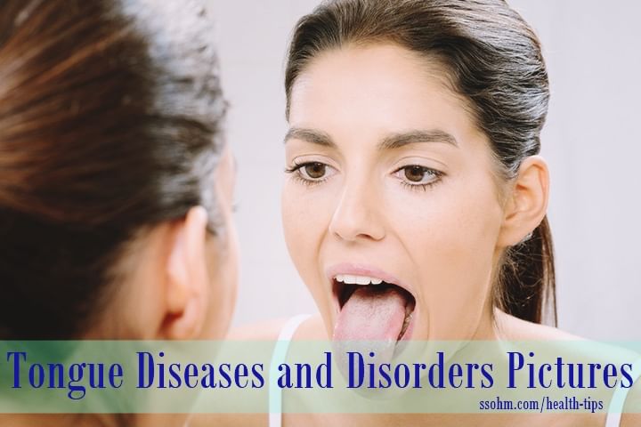 Tongue Diseases and Disorders Explained with Pictures - By Dr. X | Lybrate