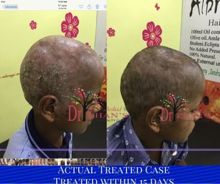 Fungal Infection on Scalp - Tinea Capitis - By Dr. Arshad Khan | Lybrate