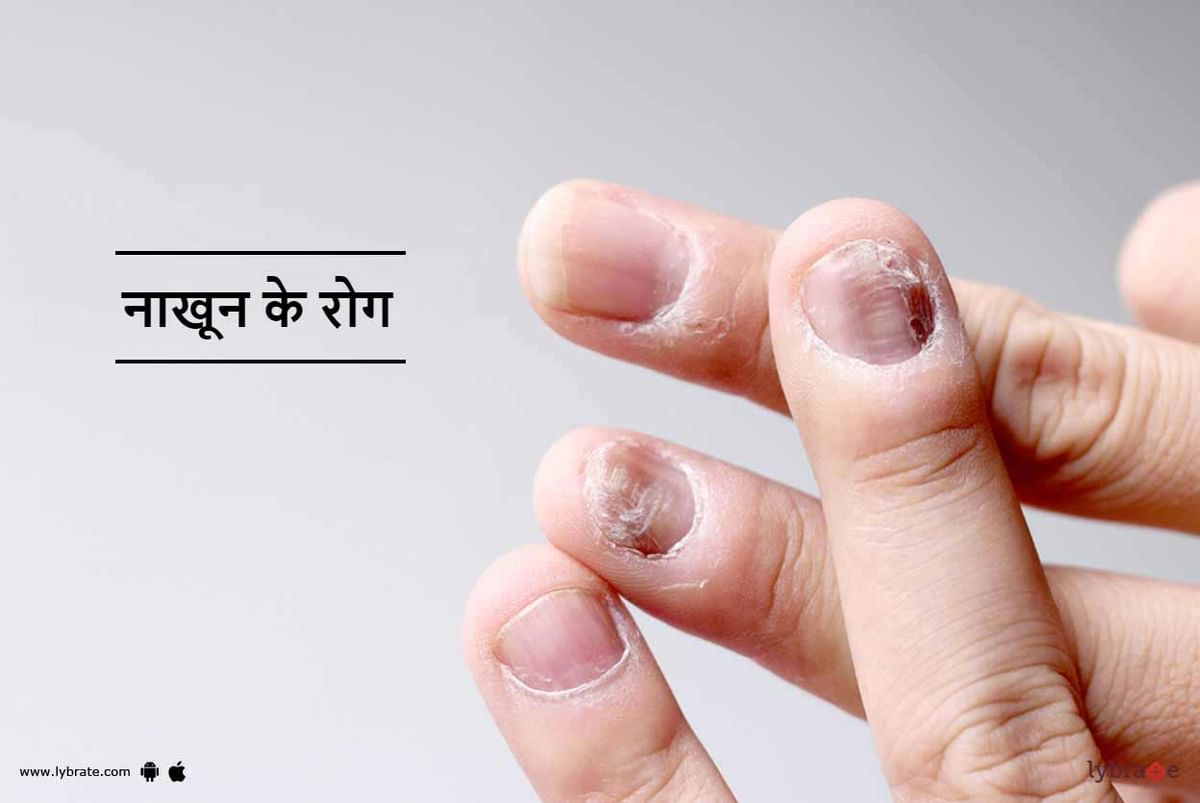 नाखून के रोग - Nakhun Ke Rog in Hindi
