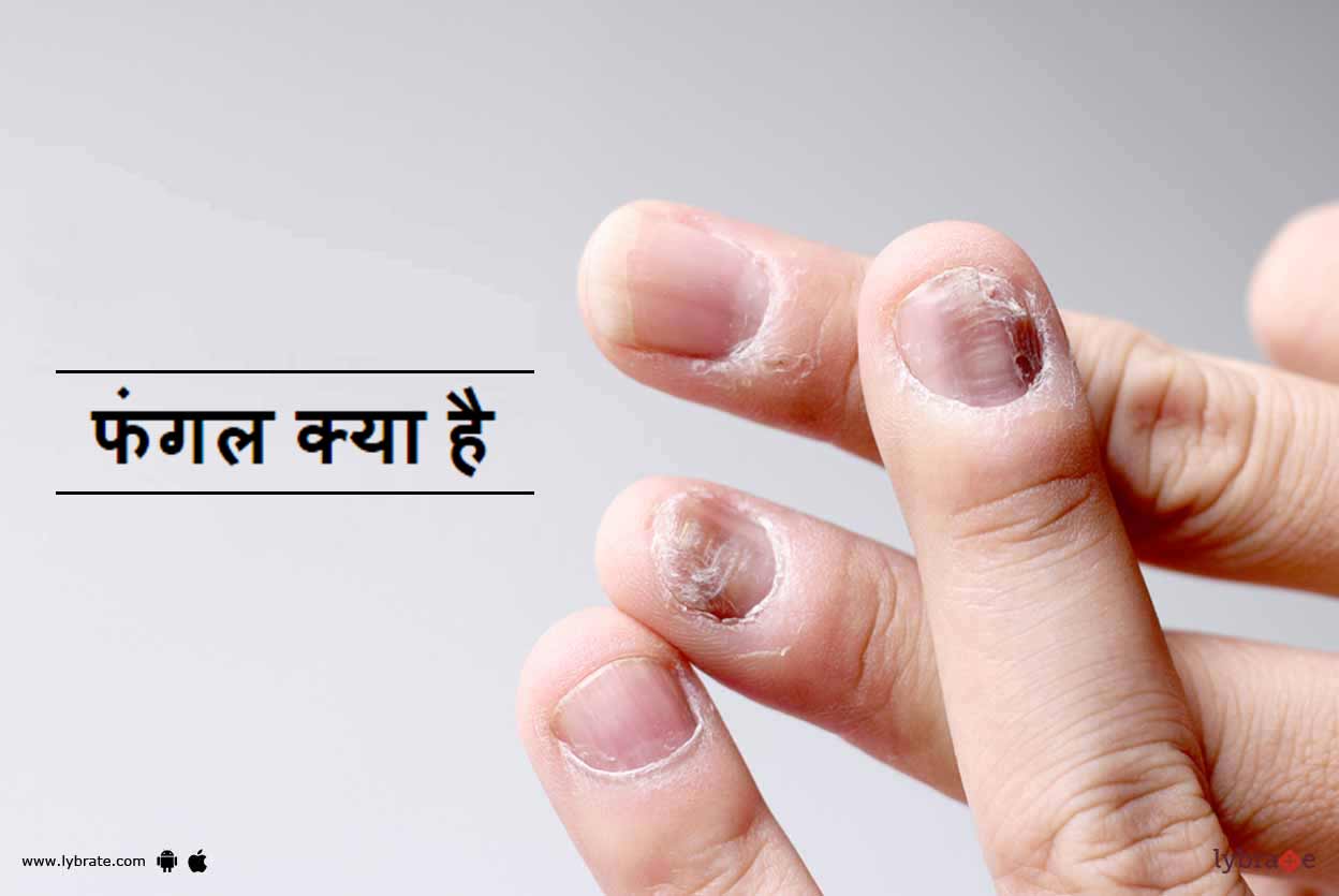 फंगल क्या है Fungal Kya Hai! By Dr. Sanjeev Kumar Singh Lybrate