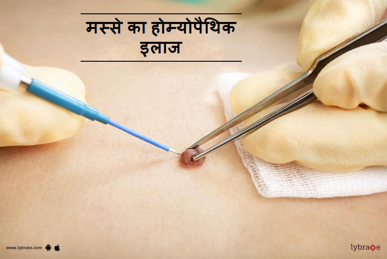 मस्से का होम्योपैथिक इलाज और दवा Masse Ka Homeopathic Ilaj in Hindi