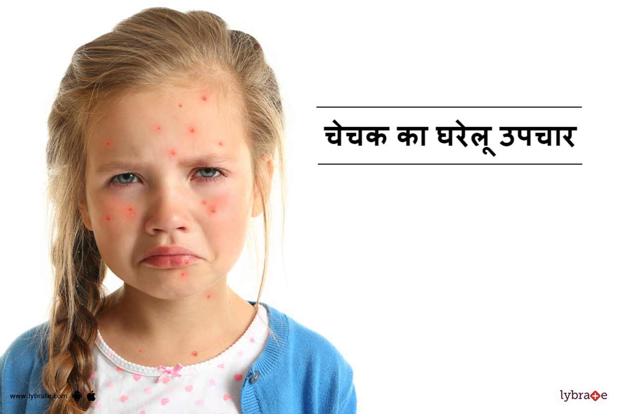 चेचक का घरेलू उपचार Chechak Ka Gharelu Upchar in Hindi