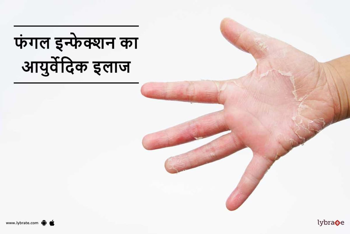 फंगल इन्फेक्शन का आयुर्वेदिक इलाज - Fungal Infection Ka Ayurvedic Ilaj in Hindi फंगल इन्फेक्शन का आयुर्वेदिक इलाज - Fungal Infection Ka Ayurvedic Ilaj in Hindi