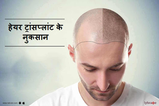हेयर ट्रांसप्लांट के नुकसान Hair Transplant Ke Nuksan! By Dr