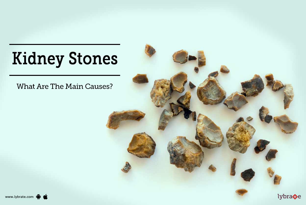 Kidney Stones What Are The Main Causes? By Dr. Garima Lybrate