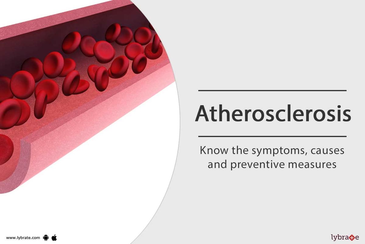 Atherosclerosis Know The Symptoms Causes And Preventive Measures By Dr Garima Lybrate 2937